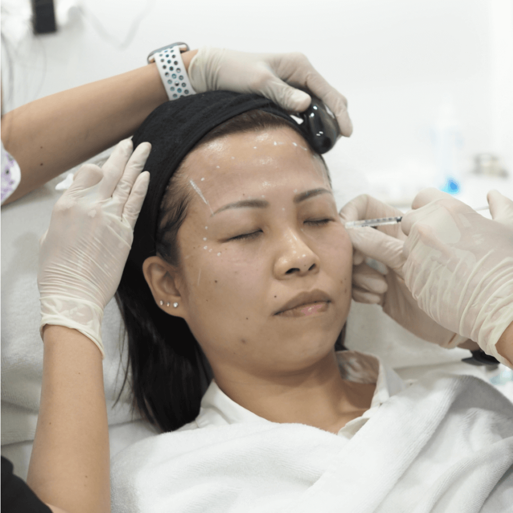 Pure* botulinum toxin injections for my crows feet