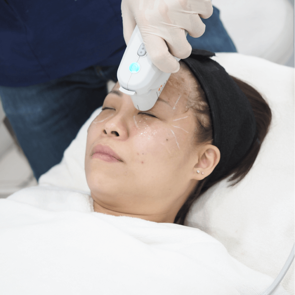Getting MFU-V to lift and tighten my face
