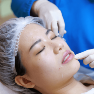 Getting dermal fillers at the corners of my mouth