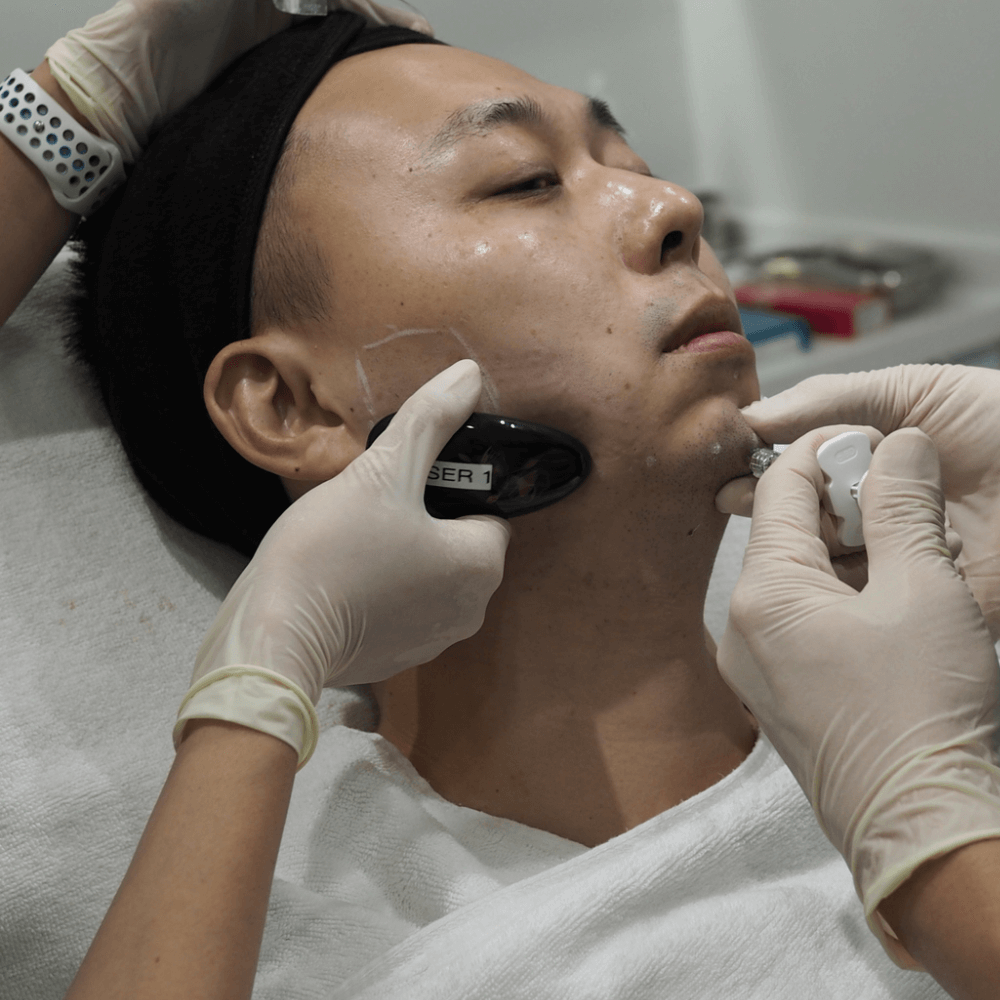 Getting fillers to enhance my chin