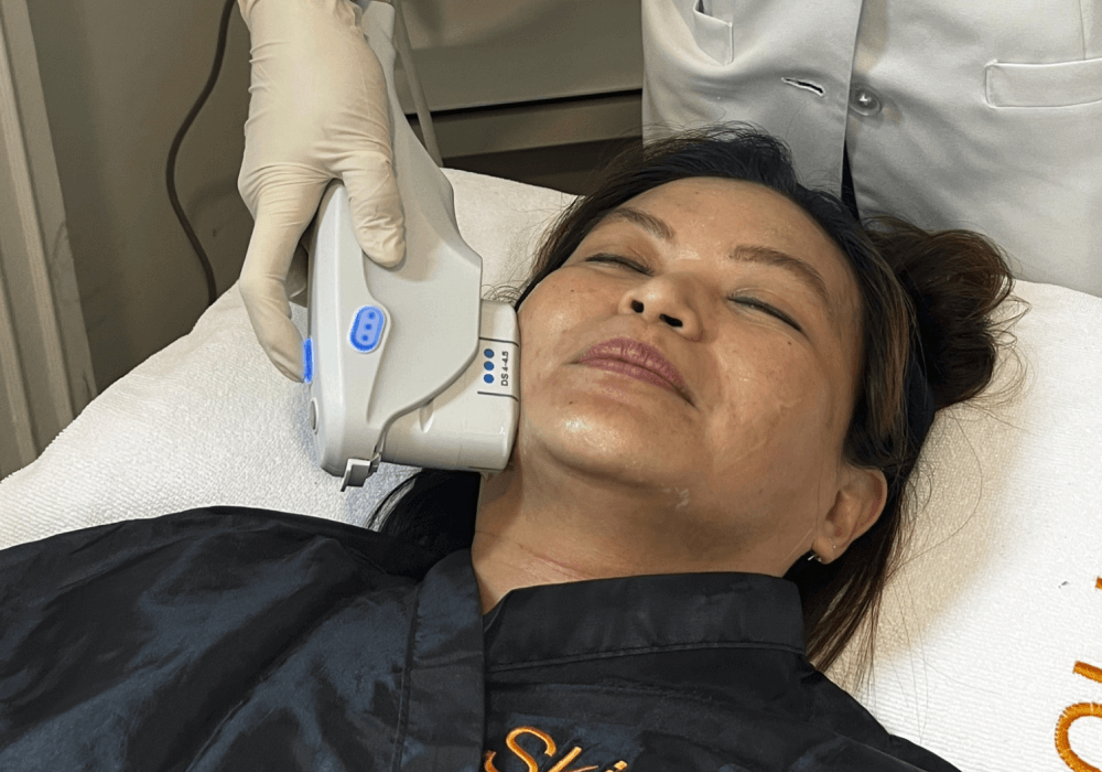 MFU-V treatment on my lower face